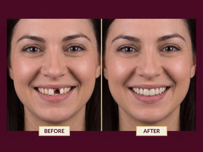 Before and after: gap of a missing front tooth filled