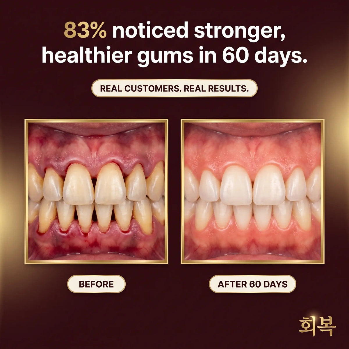 83 percent noticed stronger, healthier gums in 60 days, before and after