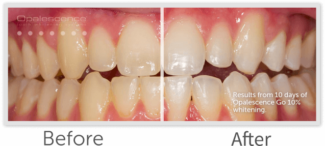 Opalescence Go™ — Prefilled Whitening Trays