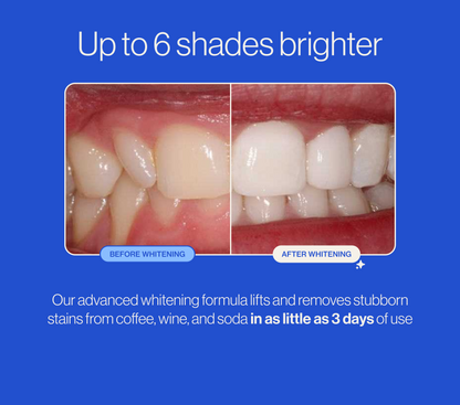 MoonWhite Whitening Tray
