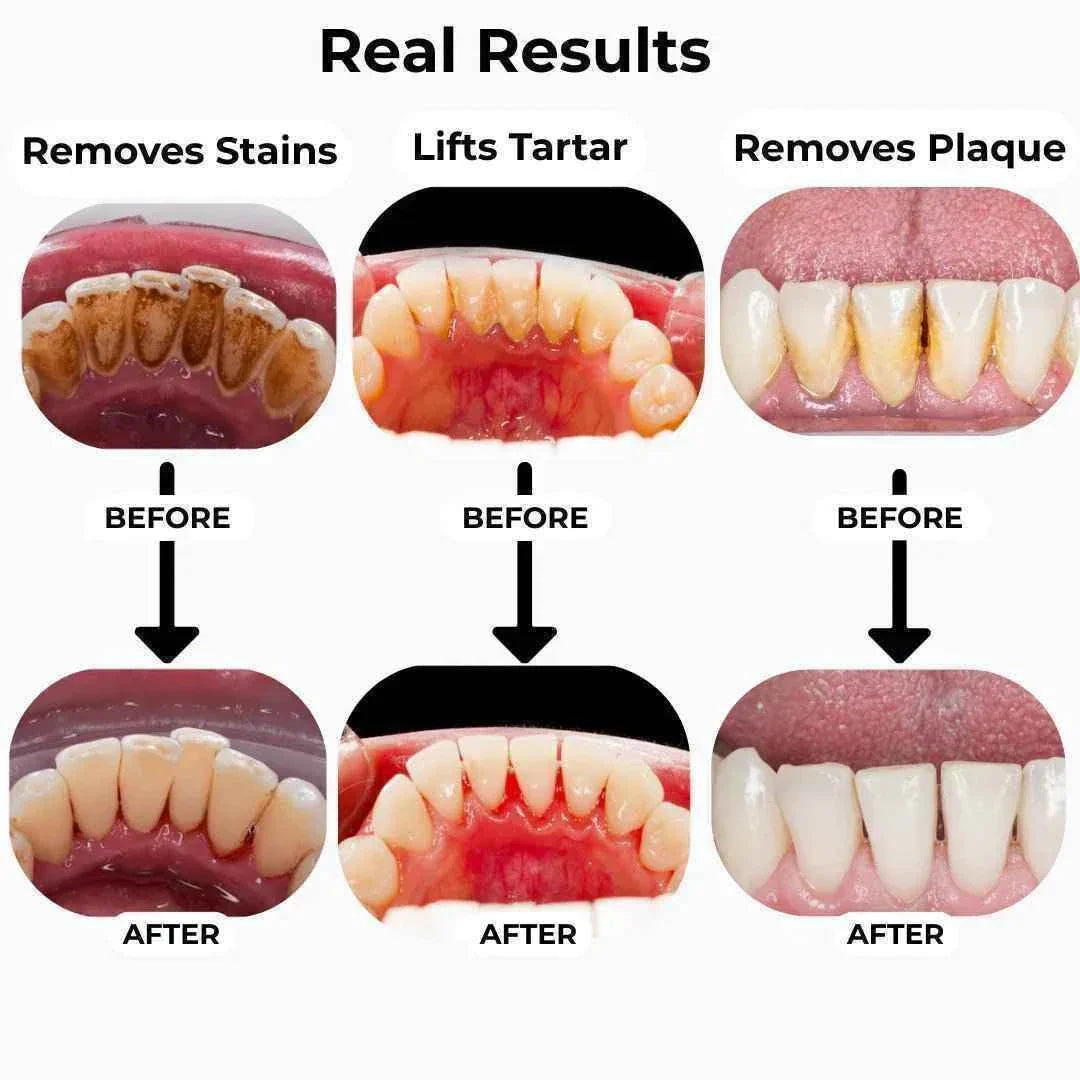 Ultrasonic Tooth Cleaner - Smart Dental Plaque Remover for Effective Oral Hygiene