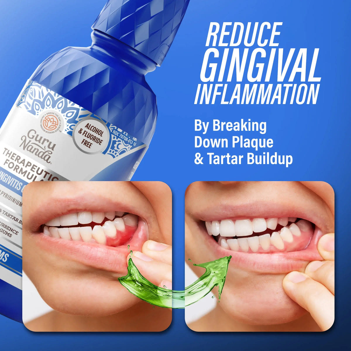 Before & after gums