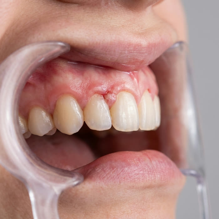 Week one — slightly calmer gums