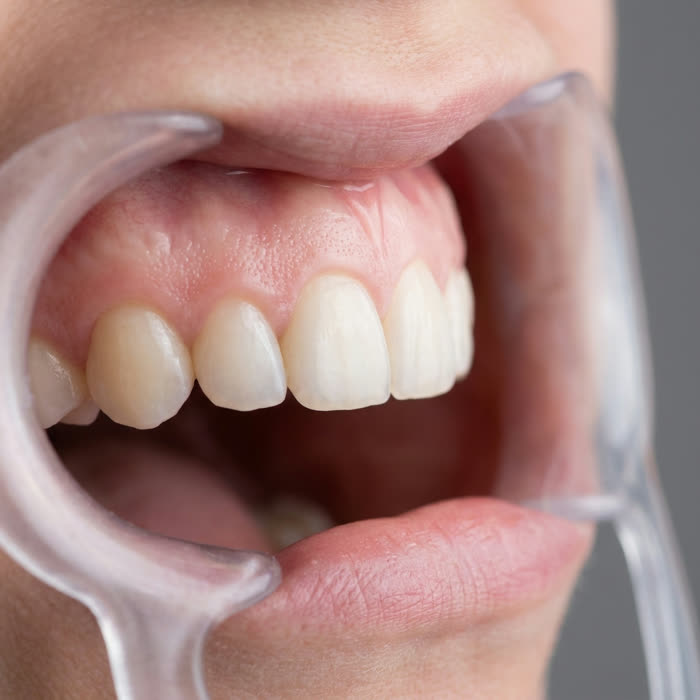 Ongoing — healthy firm pink gums