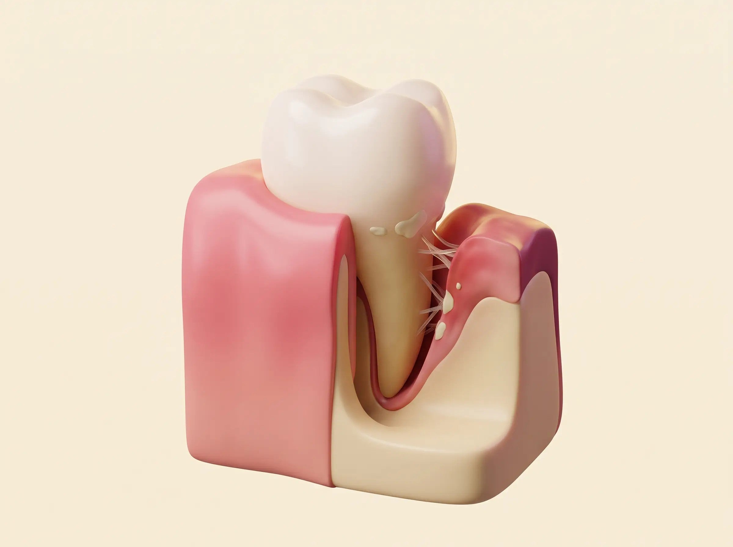 Cross-section of a tooth showing a receded gum line and exposed root