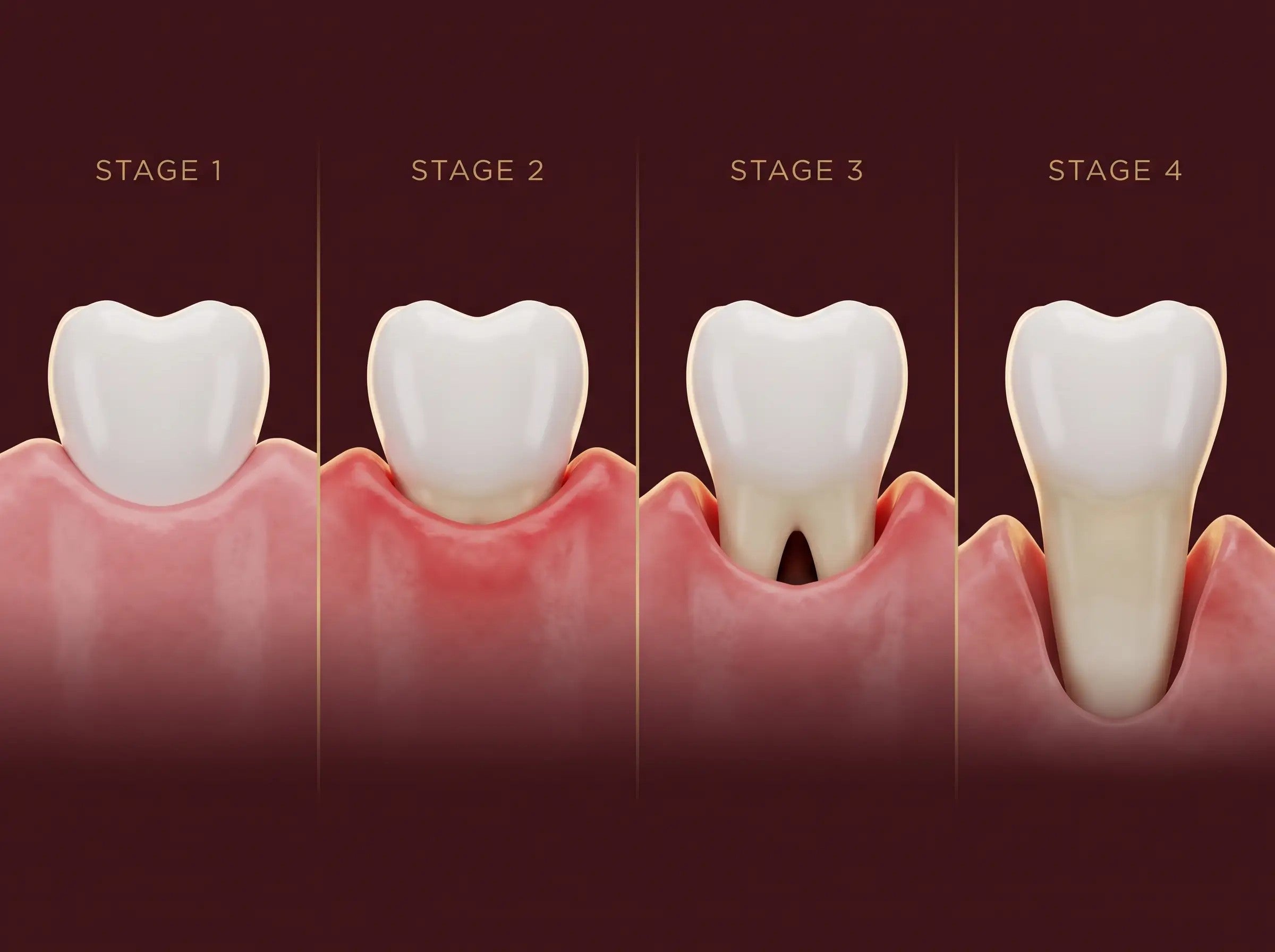 Gum recession progression from healthy gums to bone loss