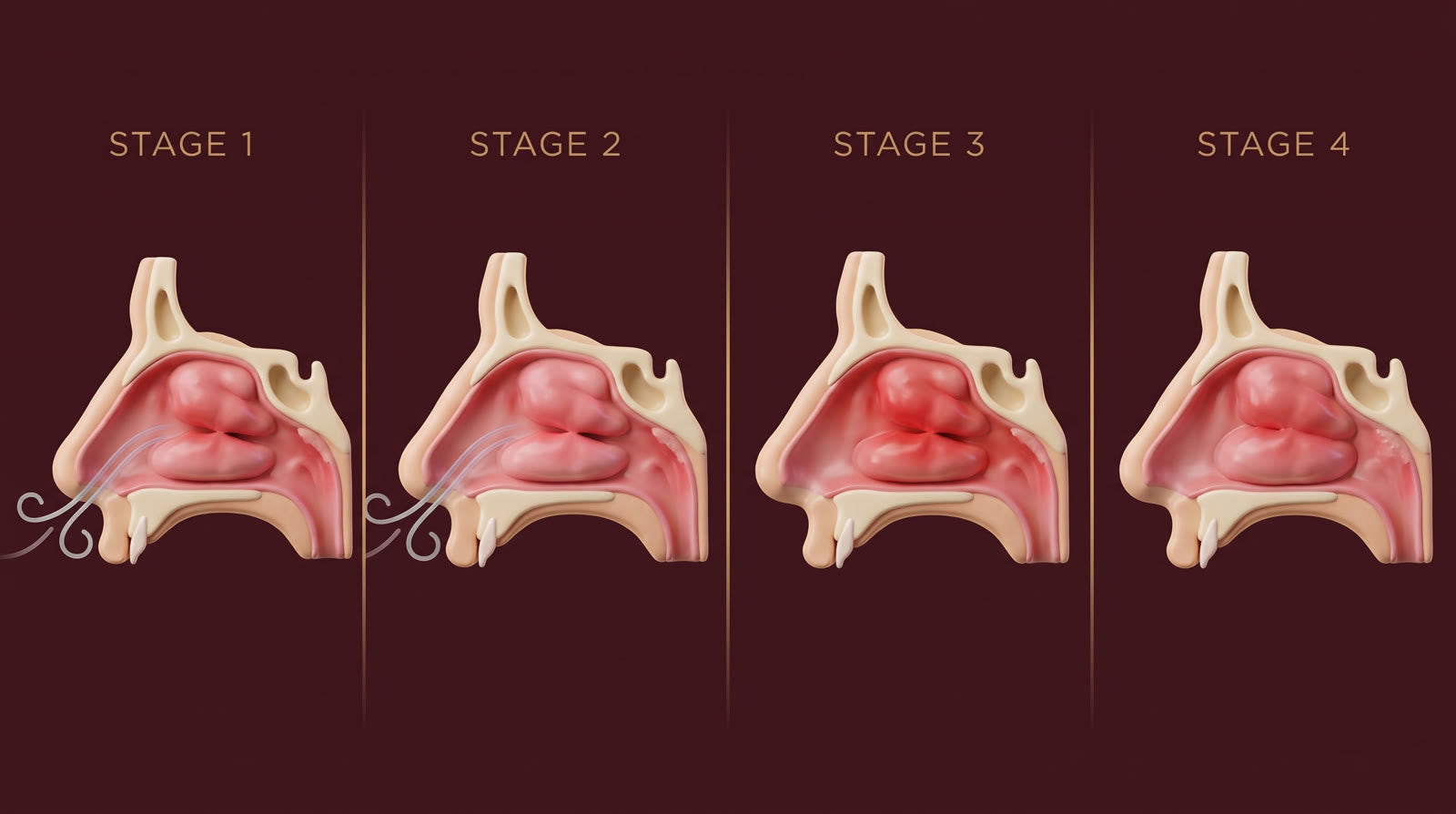 Four stages of a nasal airway getting more blocked