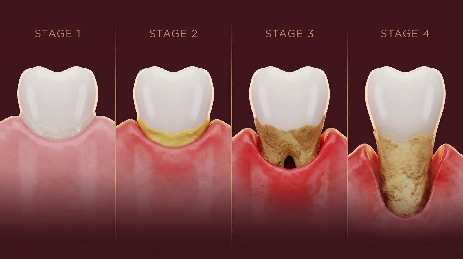 Four stages of plaque hardening into tartar and the gum pulling back